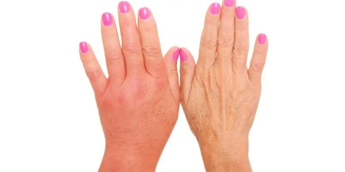 чому набрякають ноги і руки